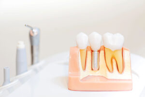 Are Dental Implants Worth the Cost