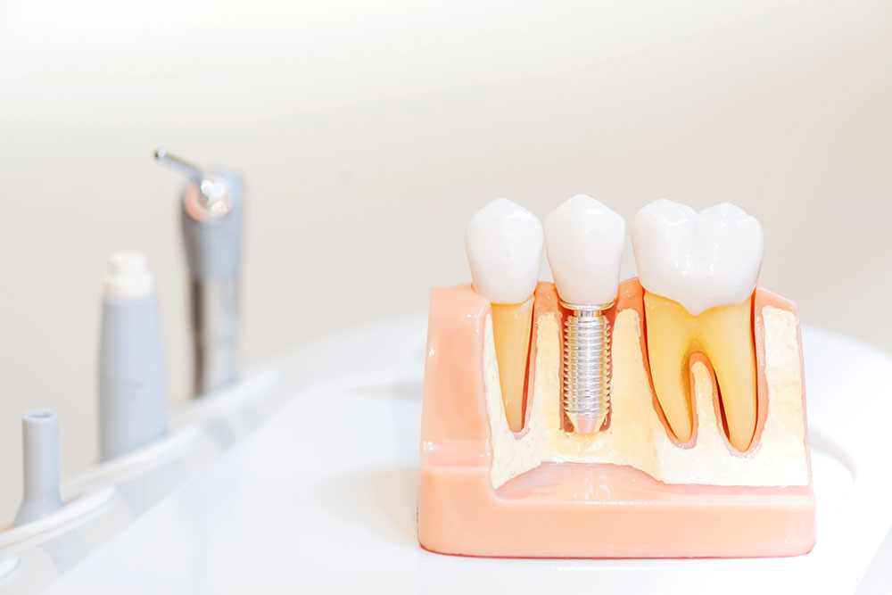 Are Dental Implants Worth the Cost