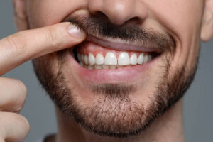 What Is Gingivitis and How Is It Treated